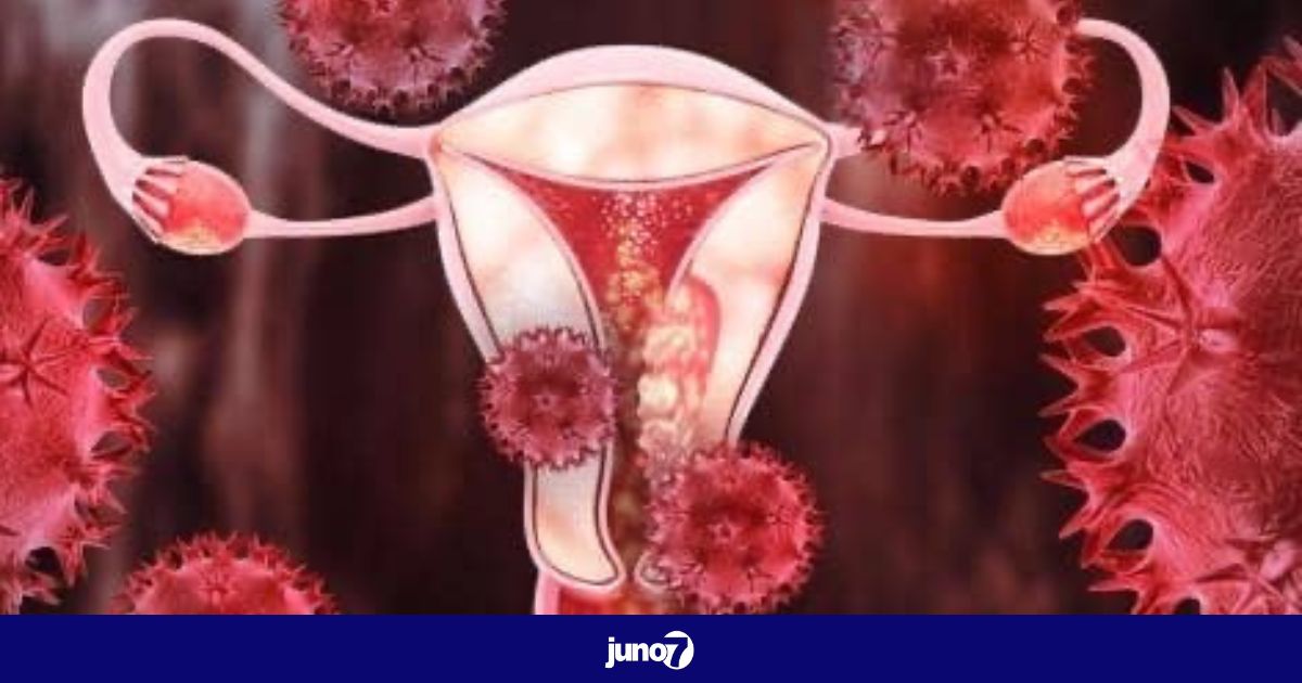 Troubles digestifs, un indicateur précoce du cancer de l'ovaire